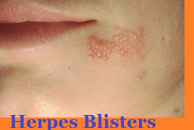 Herpes Infection blisters 123