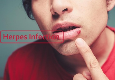 Herpes Cold Sore a